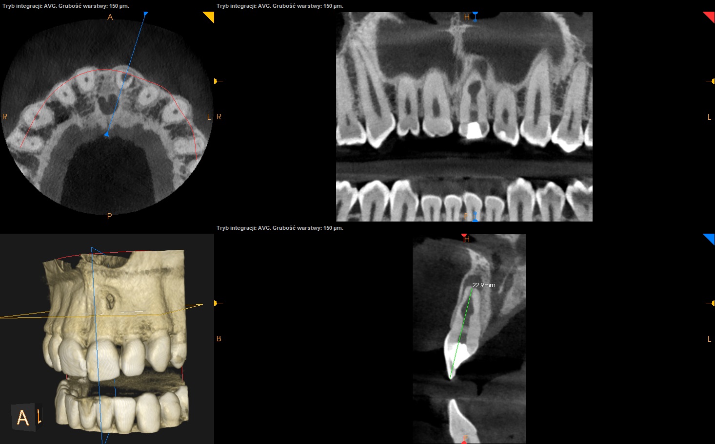 CBCT endo resorbcja