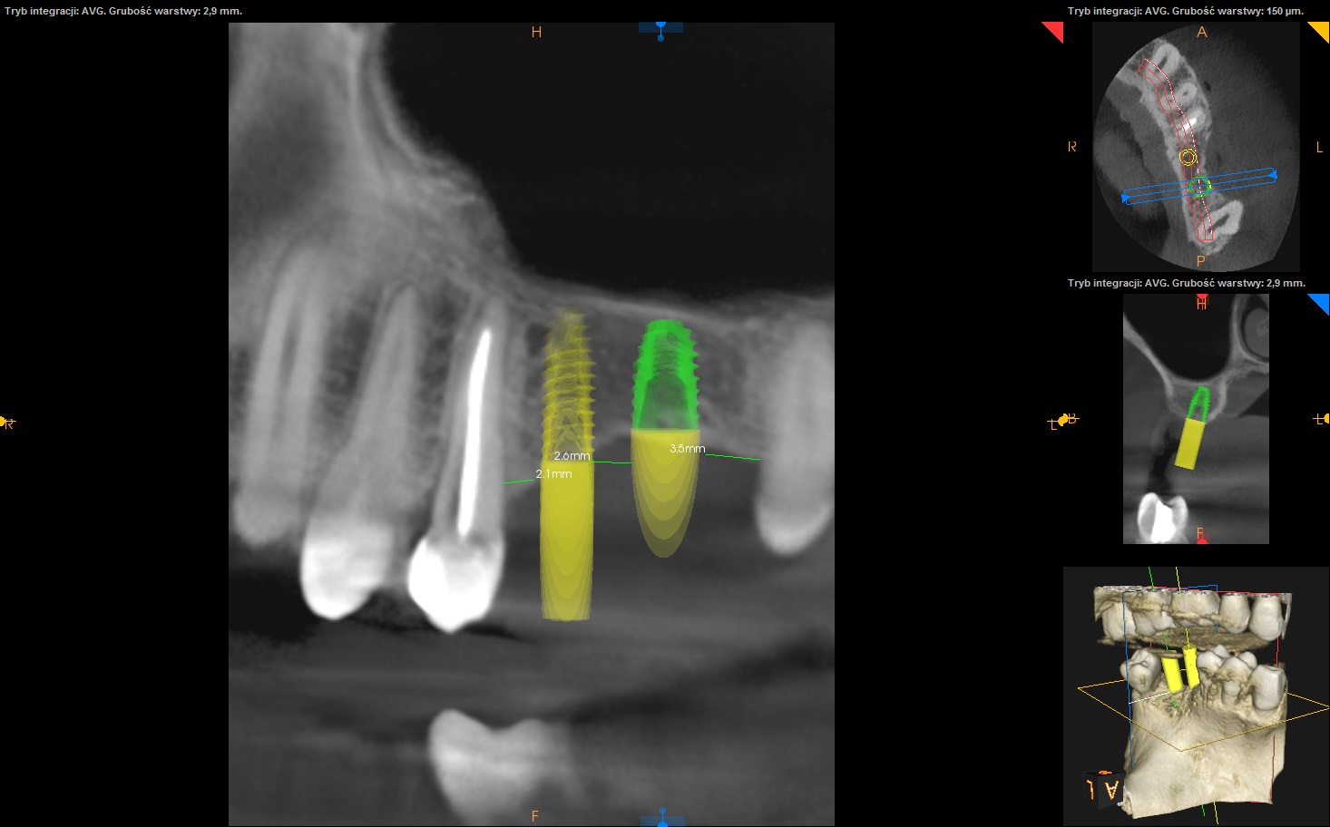 CBCT implanty