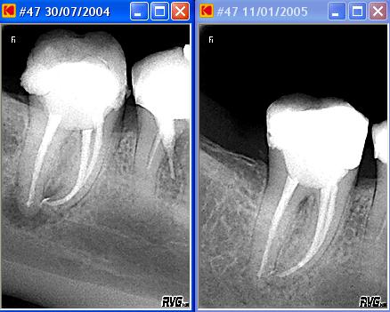 endo 5